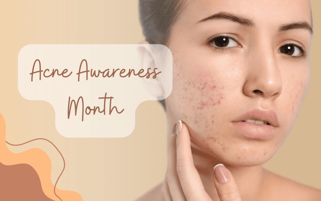 What is Acne?